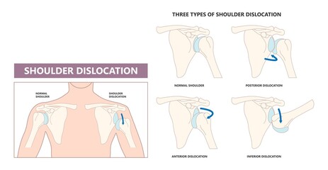 Shoulder dislocation X-ray joint arm sport lesion slap hill sachs tear torn traumatic pain broken cuff sling bone falls tendon subluxed head range of motion Superior overuse clavicle separated therapy