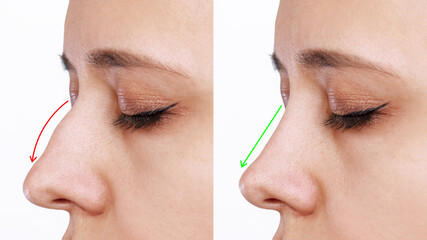 A profile of woman's face with nose before and after rhinoplasty isolated on a white background....