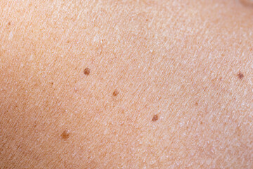 Fototapeta premium Oncology mole big wart on old woman. Concept dermatology skin cancer diseases malignant tumor