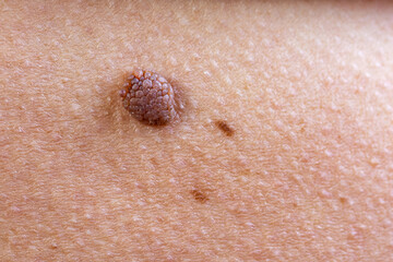 Oncology mole big wart on old woman. Concept dermatology skin cancer diseases malignant tumor