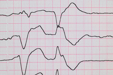 ECG with rhythm disturbance and ventricular extrasystole close-up