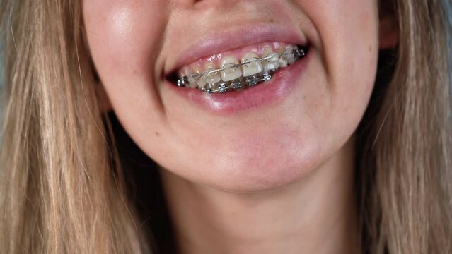 Woman smile with ceramic and metal braces. Dental teeth health care.