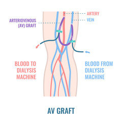 Arteriovenous dialysis shunt graft catheter for hemodialysis sessions. Arm with surgically inserted tube connecting artery to vein under skin. Medical vector illustration. - obrazy, fototapety, plakaty