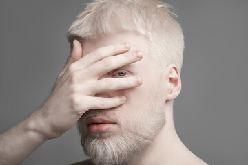 Obraz premium Uncommon albino guy closing his face with palm, looking with one eye through fingers at camera, grey studio background