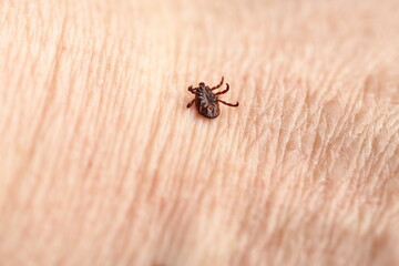 Ixodid, encephalitic live tick on the human body close-up, macro photography.