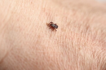 Ixodid, encephalitic live tick on the human body close-up, macro photography.
