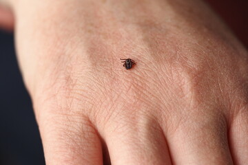 Naklejka premium Ixodid, encephalitic live tick on the human body close-up, macro photography.