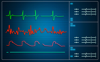 Patient monitor showing vital signs ECG and EKG.