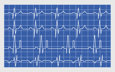 Electrocardiogram scan result vector concept. EKG monitor for emergency. Cardiac test illustration. Heart beat