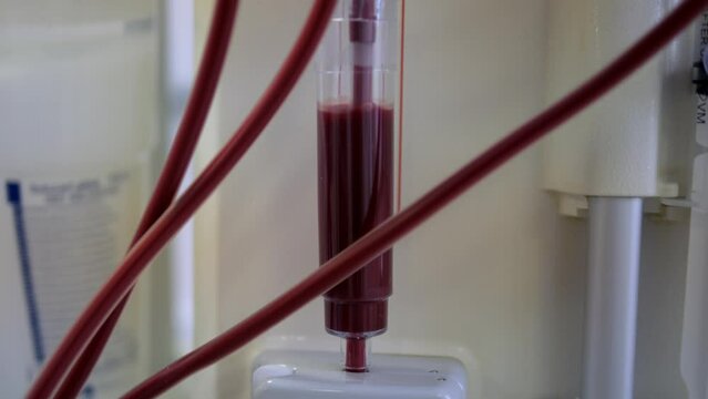 System Of Filters And Tubes Of The Hemodialysis Machine. Process Of Cleaning The Blood From Toxins.