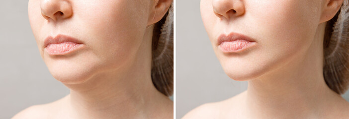 Female double chin before and after correction. Correction of the chin shape liposuction of the neck. The result of the procedure in the clinic of aesthetic medicine. - obrazy, fototapety, plakaty