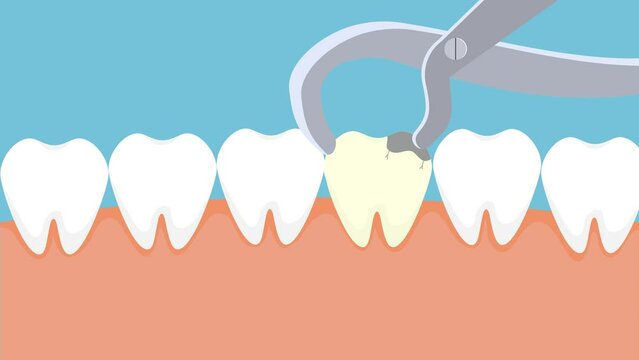 Tooth getting cavities and cracking down 4K animation. Dentist pulling up a dead tooth using dental nipper footage. Dead teeth get cracked and a dentist removes the tooth 4K animation.
