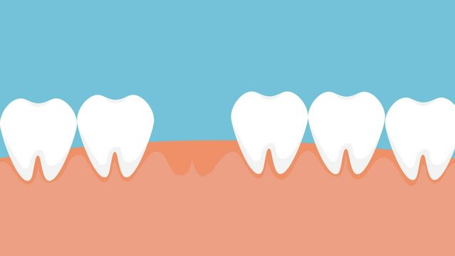Removing dead tooth with a dental nipper on a green screen and alpha channel 4K animation. Dentist pulling up a dead tooth with cavities 4K footage. Alpha channel animation with a rotten tooth.