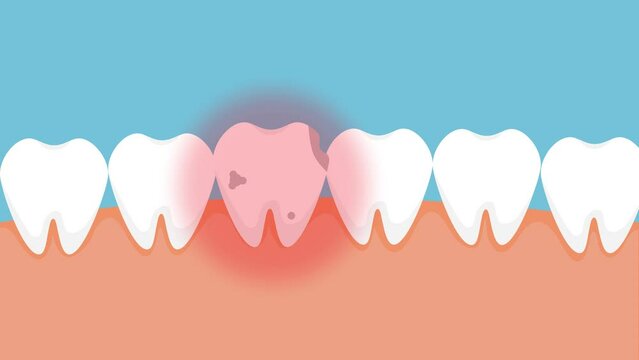 Dead tooth hurting and giving a red pain signal 4K animation. Tooth infected with cavities and hurting jaw 4K footage. A rotten dead tooth with a red danger signal and animation.