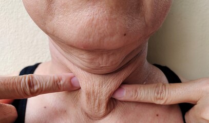 Portrait showing the fingers touching the flabbiness adipose hanging under the neck, problem skin weakness and mole on the body of the woman, concept health care.