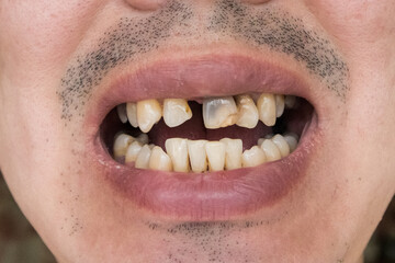 A man with crooked and yellow teeth.