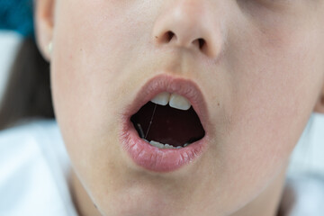 a little girl with a shifted dentition demonstrates her teeth