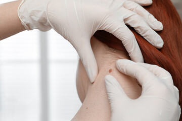 Dermatologist examining patient's birthmark in clinic, closeup view