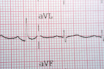 Electrocardiogram ECG in a graph paper shows normal Sinus rhythm, Vital signs and medical...