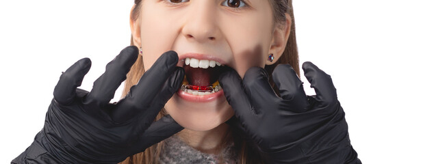 A doctor in black medical gloves tries on an orthodontic appliance for a little girl. The concept of teeth alignment in childhood. Studio photo on a white background.