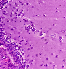Fibroepithelial polyp of tongue, show fibrocollagenous tissue lined by stratified squamous...