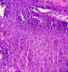 Pigmented nevus: Blue nevus of the skin. Notice the brown pigment in the dermis. Microscopic view.