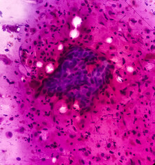 Squamous intraepithelial lesion(SIL). Pap's smear. Reactive cellular changes associated with severe inflammation. Focus view.