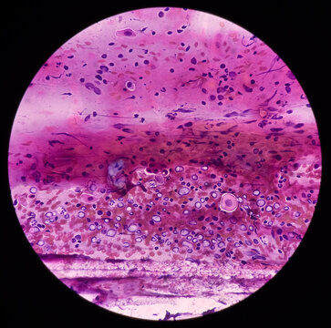 Squamous intraepithelial lesion(SIL). Pap's smear. Reactive cellular changes associated with severe inflammation. Focus view.