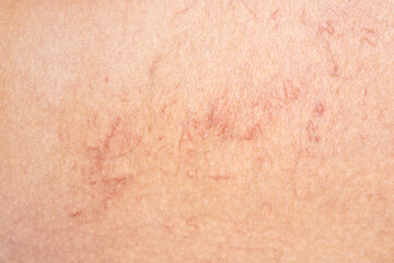 Fototapeta premium Removal of varicose veins on the legs. Medical inspection and treatment of Telangiectasia. Phlebeurysm.