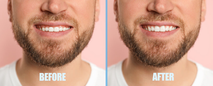 Young man before and after gingivoplasty procedure on beige background, closeup. Banner design
