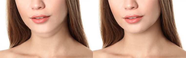 Double chin problem. Collage with photos of young woman before and after plastic surgery procedure...