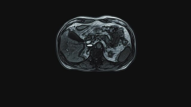 Voluminous color CT scan of the abdomen. Computed tomography of the gastrointestinal tract, liver and kidneys