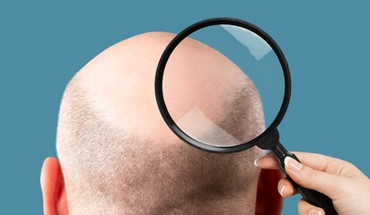 A man with alopecia on his head. The doctor's hand holds a magnifying glass at of baldness.