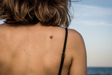 Close-up of Female Back with Large Freckles and Small Freckles with Black Bikini Strap in front of...