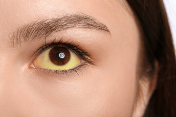 Young woman with yellow eyes, closeup. Hepatitis symptom