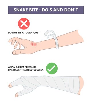 Snake Bite First Aid Care Non Venomous Anti Venom Serum Hand Leg King Cobra Treat Kit Death Injury Help Safe Call Pain Blood Healing Prevent Coral Fangs Step Poster Grabbing Splint Limb Sign Tongs