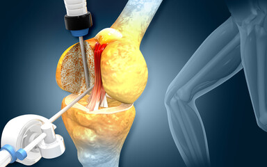 Human knee surgery on scientific background.3d illustration