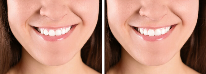 Young woman before and after gingivoplasty procedure, closeup. Banner design
