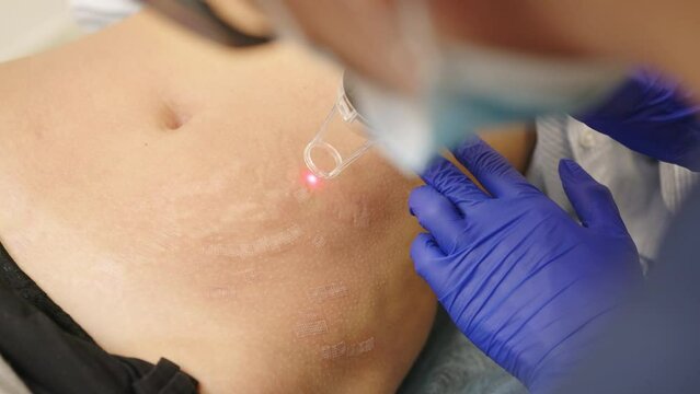Woman getting a laser skin treatment or Laser resurfacing of scars in a skincare cosmetology clinic. Resurfacing technique for wrinkles, scars and solar damage to the skin