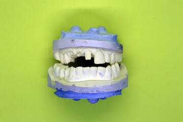 Plaster casts of teeth. Preparation for prosthetics. Installation of implants.