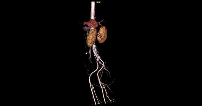 CTA Whole aorta 3D rendering turn around on the screen for diagnosis Aortic dissection or aneurysm.