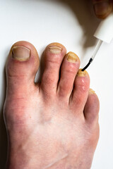 Fototapeta premium Using a varnish against nail fungus. Nail fungal infection treatment.