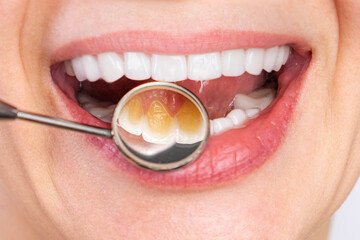 Before after perfect white veneer teeth smile with dental mirror close up, view of outside and...