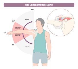 Rotator cuff SLAP tear torn pain injury tendon muscle joint X-ray range of motion space arm arc spur bone bursa sport overuse biceps tendinopathy labral tears rehab bankart lesion dislocated glenoid