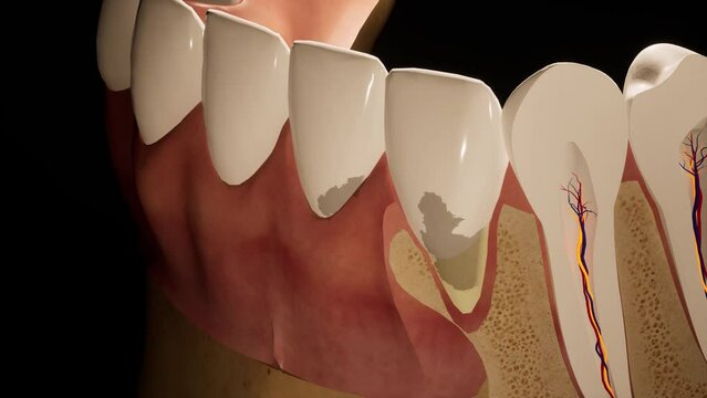 Molar teeth damaged by caries. Medically accurate tooth 3D animation