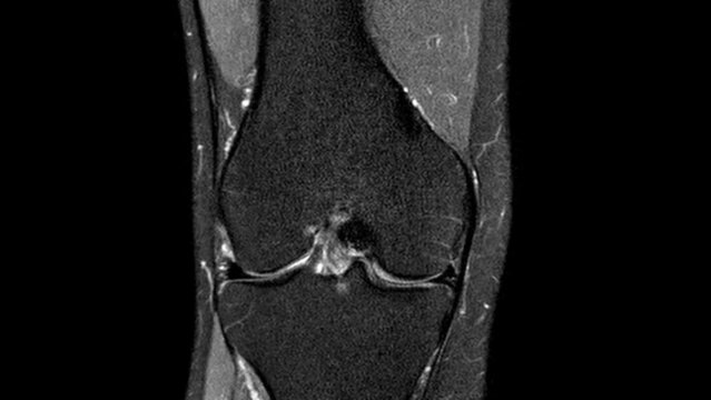 MRI knee joint. Magnetic resonance imaging of right knee. The concept of medical diagnosis of joint injuries. Diagnosis sport trauma and damage of ligaments.