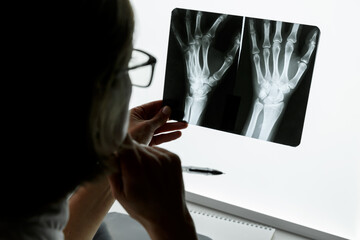 Surgeon Traumatologist  examining an x-ray of the traumatised wrist. - 501615018