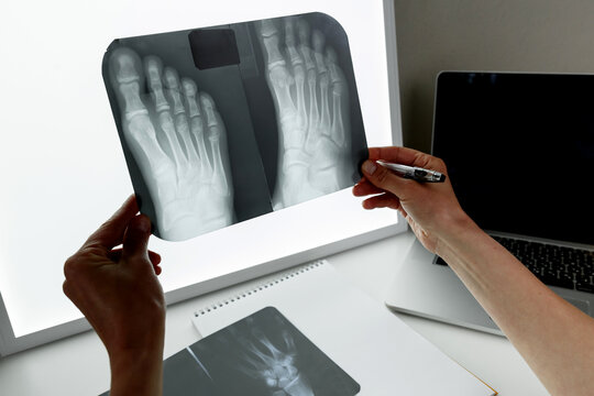 Orthopedic surgeon examining an x-ray of the foot.