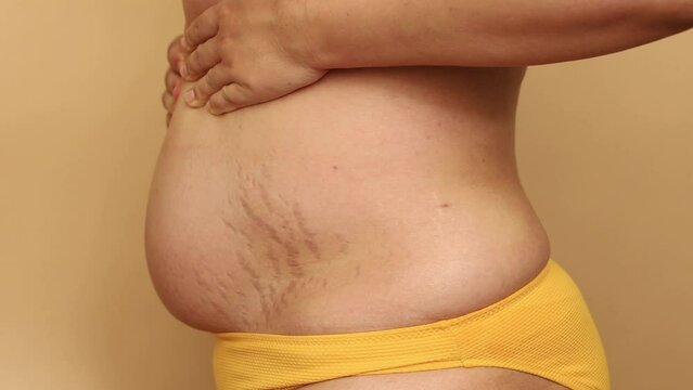Side view of unrecognizable fat plump woman wearing yellow bra, bikini, lifting excess subcutaneous fat of belly, showing stretch marks on beige background. Body positive, weight loss, liposuction.
