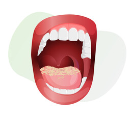Open Mouth with Fungal Infection on Tongue - stock illustration